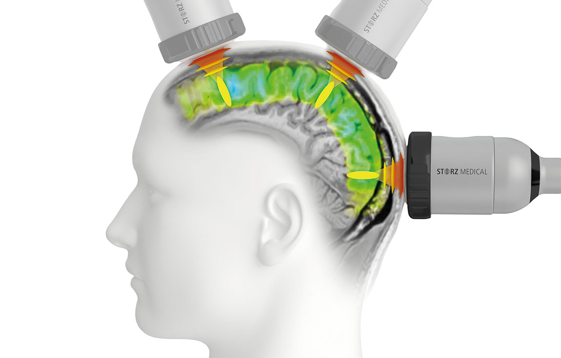 NEUROLITH – Mit TPS können Gehirnregionen gezielt stimuliert werden